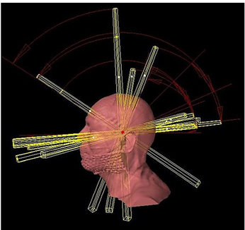  A three-dimensional view of a treatment plan to treat a very small tumor in left trigeminal nerve using a fixed virtual cone technique. The fixed virtual cone is characterized by 0.5 cm x 0.5 cm high-definition (HD) MLC field, defined by two pairs of central leaves of the HDMLC.
